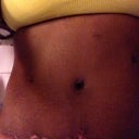 Yuck scab coming off so this looks nasty..,