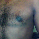 left niple, more puffy, scar like two skin joint, will this ever get filled that gap??