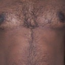 i look better before surgery, bit liposuction could have done better