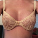 Day 11. Still have a small bruise on upper left breast. Fitting into  36 C bra
