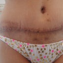 3 weeks post op