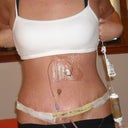 April 9th, 4th day post op