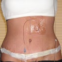 April 9th, 4th day post op