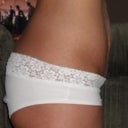 March 21st Pre-Op side view