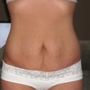 March 21st Pre-Op Front view