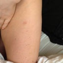 One year later, and there are ten of these liposuction scars on my legs. They are perfectly symmetrical on each side, so it's very obvious what they are. No bikinis for me this summer.