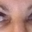 1 hour after procedure. Swelling on lids only.