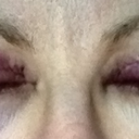 Day after procedure (Day 2) - Eyes closed. Bruising starting to appear under the right eye (on the left in the pic)