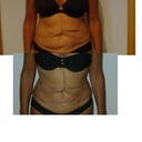 Before and Four Days After
