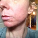 Day 5 after first Fraxel- 3/4 view