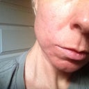 Day 5 after first Fraxel- other 3/4 view