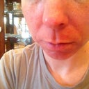 Day 5 after first Fraxel- straight on.