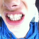 Aligner # 4 ( Is it me or do my teeth get whiter with every new aligner.)