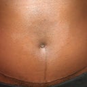 11 weeks post-op