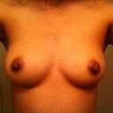 Before Front View(Left boob was a little smaller)
