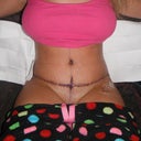 Day 6 PO Still swollen but I am very happy so far!