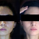Before mild acne but really oily face. After, clean, matte but radiant face, smaller nose (maybe due to less inflammation of the skin)