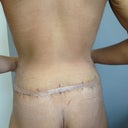 ONE-WEEK POST-OP:  Dr. Khuthaila actually pulled up my butt to perform the lower body lift.  (.. Thanks to her, here's walking proof that, within a week, you can feel great and heal very well with your incisions)