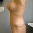 ONE-WEEK POST-OP: lower body lift, breast lift, and breast implants - as performed by Dr. Khuthaila of NYC  :)  ...ready to go.  Her expertise, knowledge, attentiveness, and talent make Dr. Khuthaila a really special surgeon.