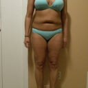 Pre Op in my blue bikini....this is exactly why I never wore a bikini.