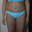 Post Op Day 14.  Holy Schnickies Batman!!!!!!!!!!!!!!  Whose body is this?  Oh wait, Its mine!!!!  Where the pool?!