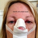 Close up. not too much in the black eye dept. Mind you this was a major, open Septo/Rhino.
