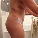 Post op day 1