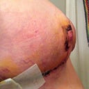 Side with lipo drain scar