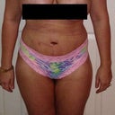 FRONT VIEW Still swollen and a bunch of marks from the binder... DAY !!