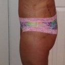 SIDE VIEW DAY 11...still swollen but almost standing straight up and it is flat