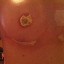 Nipple reduction :) it's got yellow gauze but they aren't droopy woo hoo!!