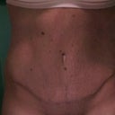 Front view of scar at 4 weeks