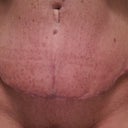 Scar doing well.! 4wk
