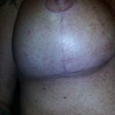 Right breast 4 wk. scars doing great