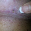 Pic of a stitch spitting I think on underside of left breast. 4wk