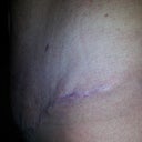pic of left hip scar. 4wk