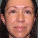 Before Active FX treatment.