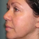 Before Active FX treatment