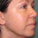 Before Active FX treatment
