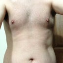 Pre-op torso