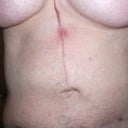 This is the infection area when it started to get red (before detection and surgery).  Posting so others might recognize an active infection if they see this.  This is a better picture of my belly button too.  Note this belly button was much better than my first one that was one inch to the right of where it should be.