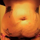 After up and down weight and two pregnancies, my skin just didn't bounce back. Just under 5 pounds of excess skin and flesh were removed.