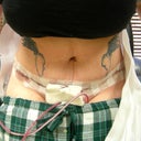 less than 24 hours post op. This is what I'm looking forward to after the swelling goes down!