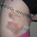 A belly chain/belt is great for hooking the drains on when you shower. I knew I kept that thing for something! Lots of bruising day 3 and 4.