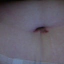 Day 6 post-op. Belly button is discharging slight liquid and has some crust but doesn't hurt.