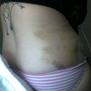 Day 6 bruising is almost gone. Drains are putting out very little.