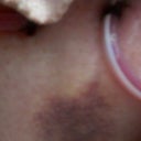 Day 4 bruising below drain site. My drains are in the pubic area and yes, that bruised spot was sore as heck.