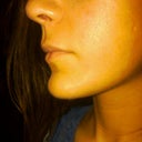 2.5 weeks after surgery
(look at the left picture of the blue background image to really compare the side profile..)