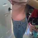 3 months post op.