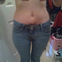 3 months post op.